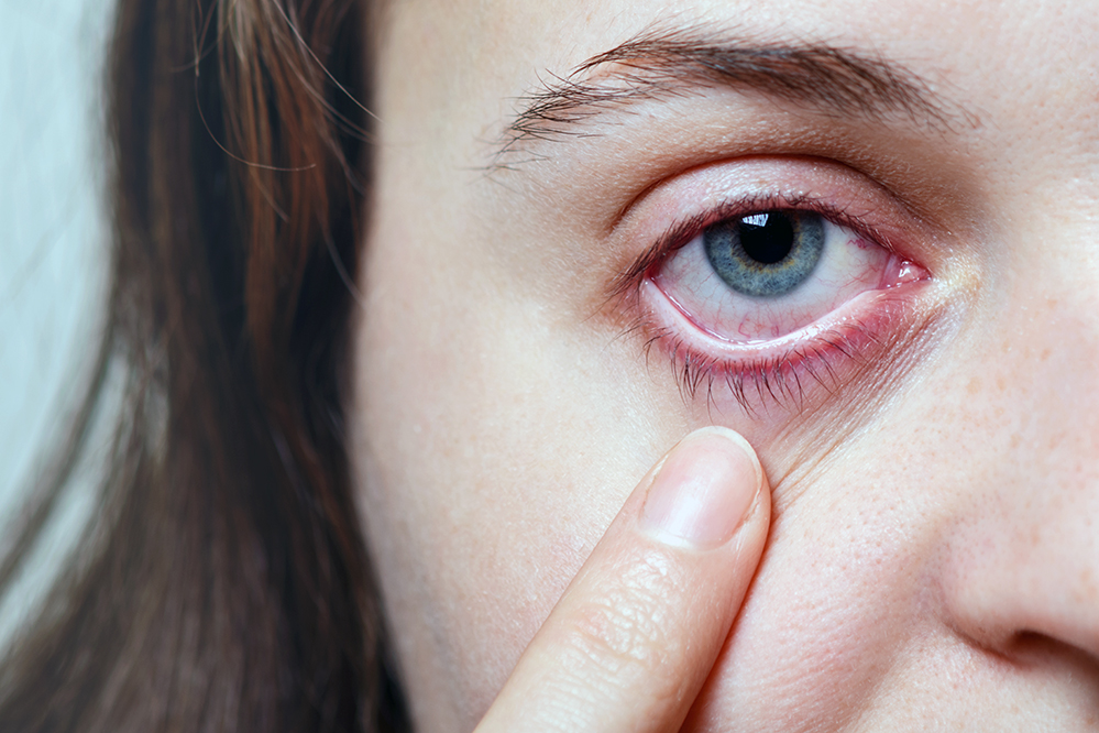 眼科脈衝光有效根治乾眼！瞼板腺功能障礙常見原因、症狀全解析